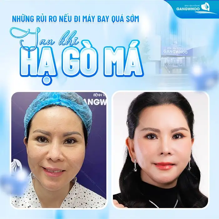 Những rủi ro nếu đi máy bay quá sớm sau hạ gò má