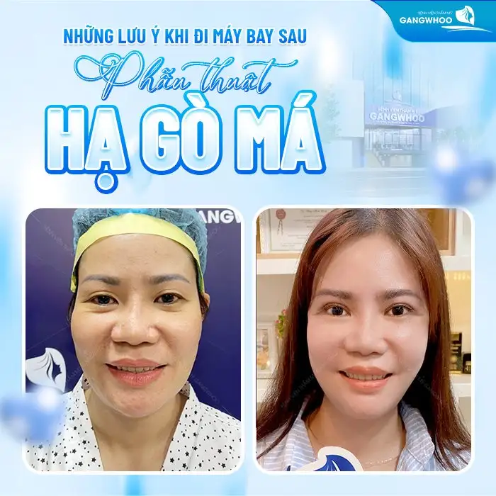 Lưu ý khi đi máy bay sau phẫu thuật hạ gò má