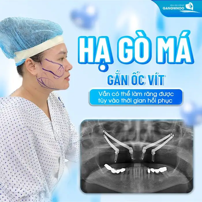Hạ gò má gắn ốc vít vẫn có thể làm răng được tùy vào thời gian hồi phục