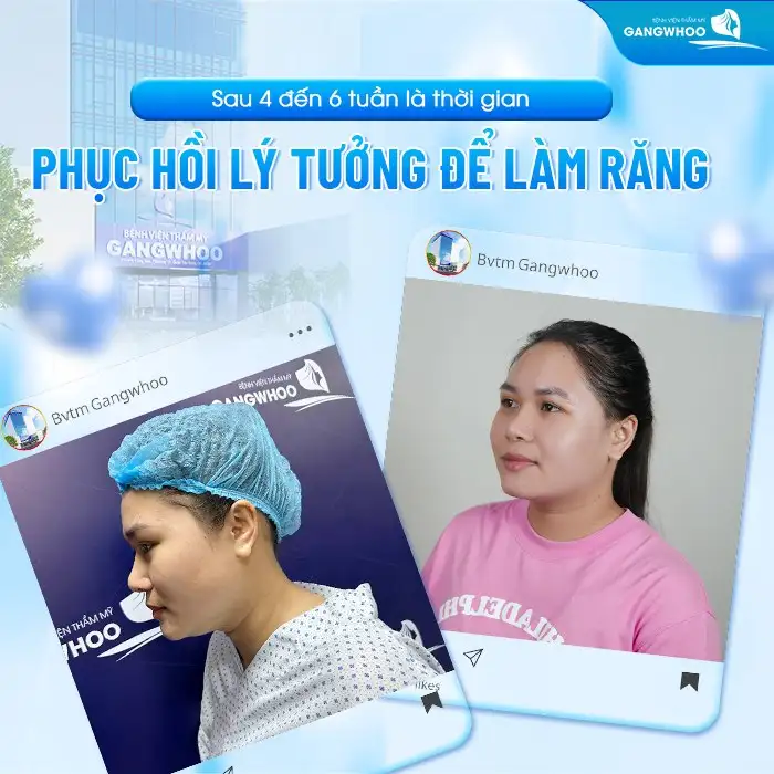 Sau 4 đến 6 tuần là thời gian phục hồi lý tưởng để làm răng
