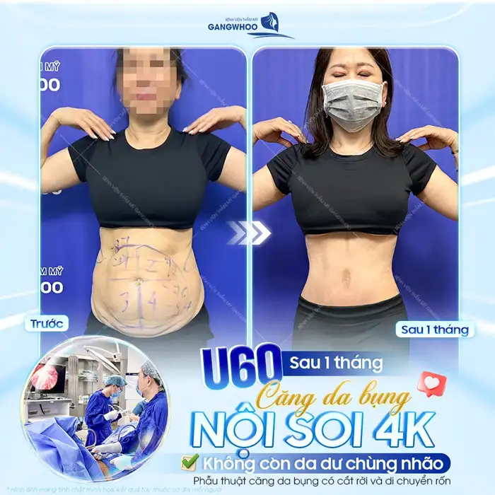 Căng Da Bụng (Abdominoplasty) Là Gì? Chi Phí, Hồi Phục & Kết Quả Thực Tế