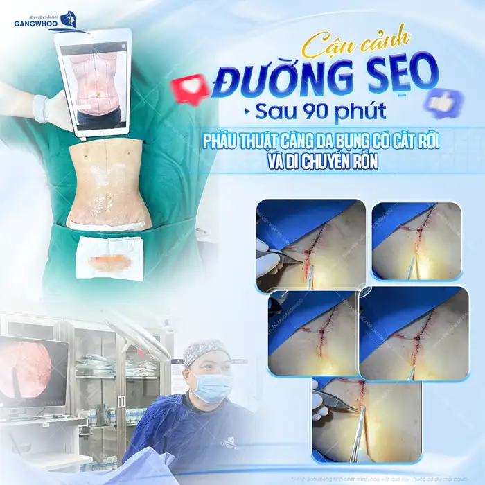 Căng Da Bụng (Abdominoplasty) Là Gì? Chi Phí, Hồi Phục & Kết Quả Thực Tế
