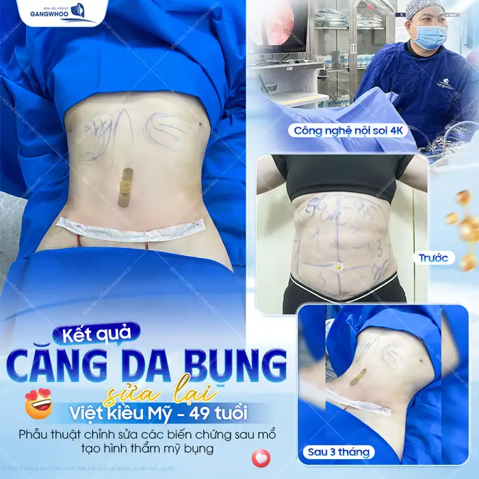 Căng Da Bụng (Abdominoplasty) Là Gì? Chi Phí, Hồi Phục & Kết Quả Thực Tế
