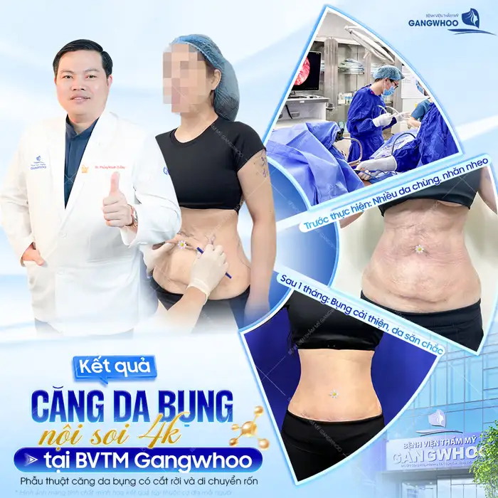 Căng Da Bụng (Abdominoplasty) Là Gì? Chi Phí, Hồi Phục & Kết Quả Thực Tế