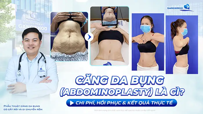Căng Da Bụng (Abdominoplasty) Là Gì? Chi Phí, Hồi Phục & Kết Quả Thực Tế