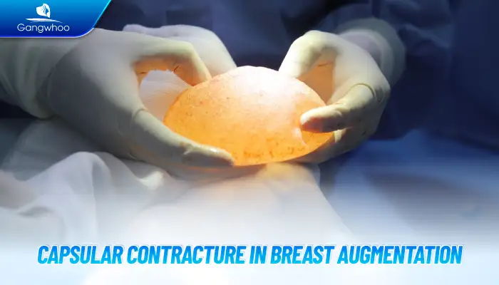 What is capsular contracture after breast augmentation? What causes capsular contracture?