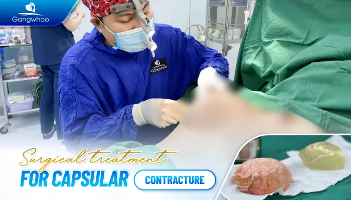 What is capsular contracture after breast augmentation? What causes capsular contracture?