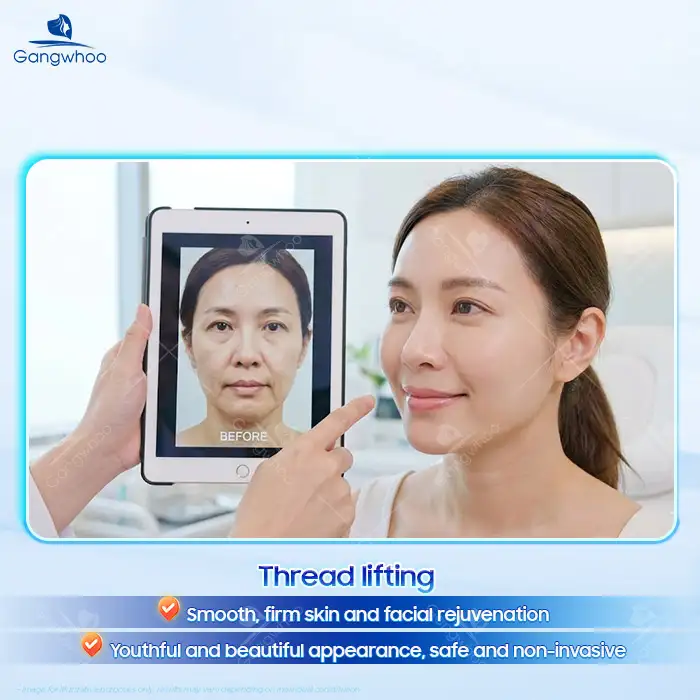 How Much Does a Thread Lift Cost? Updated Thread Lift Price List 2025