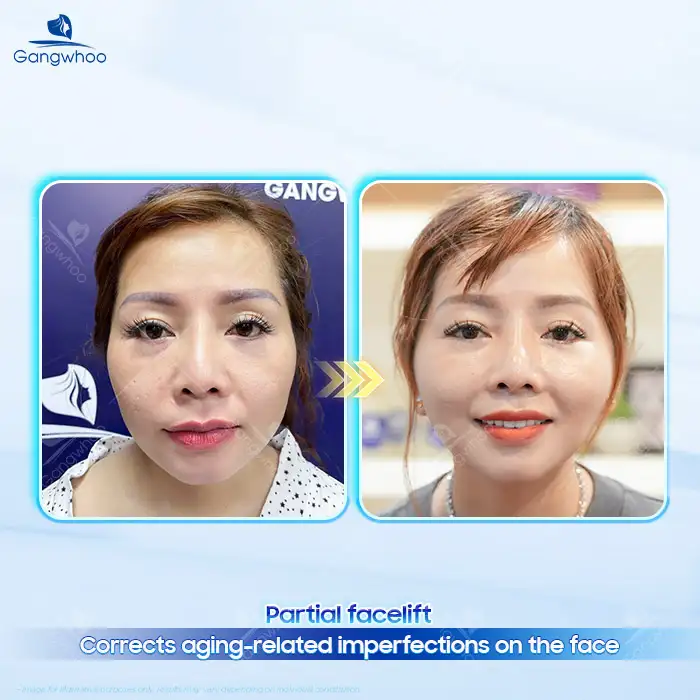 What Is a Partial Facelift? Advantages and Disadvantages of a Partial Facelift