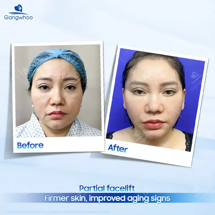 What Is a Partial Facelift? Advantages and Disadvantages of a Partial Facelift