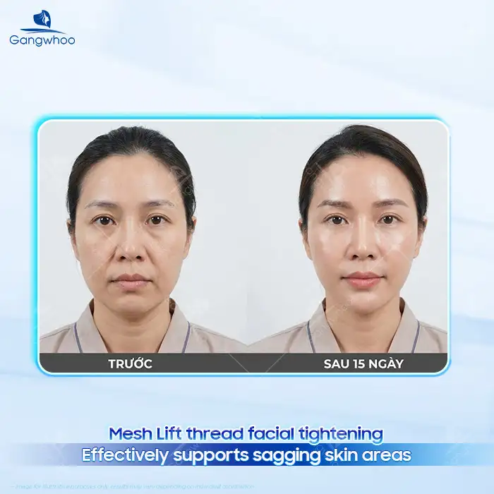 en cang da mat bang chi mesh lift 1