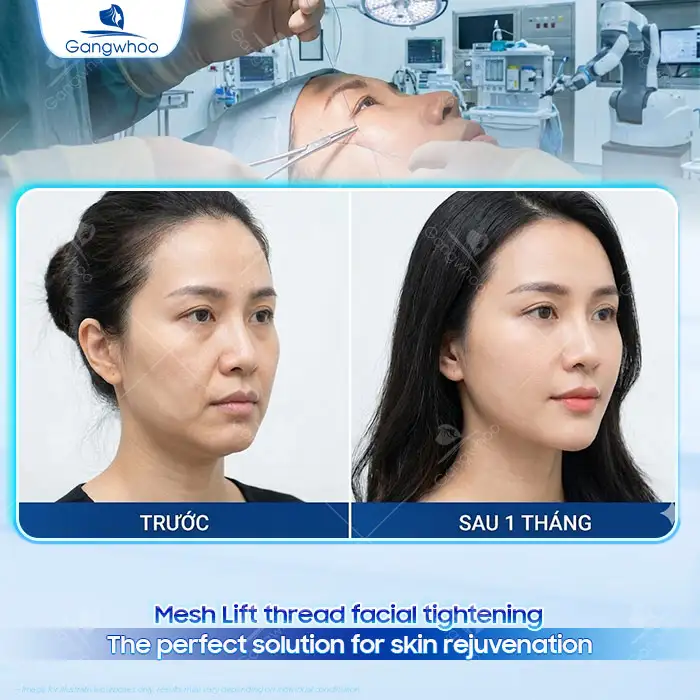en cang da mat bang chi mesh lift 2