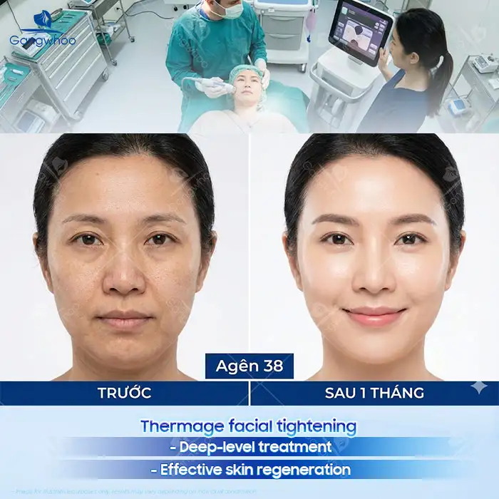 en cang da mat thermage duoc bao lau 2