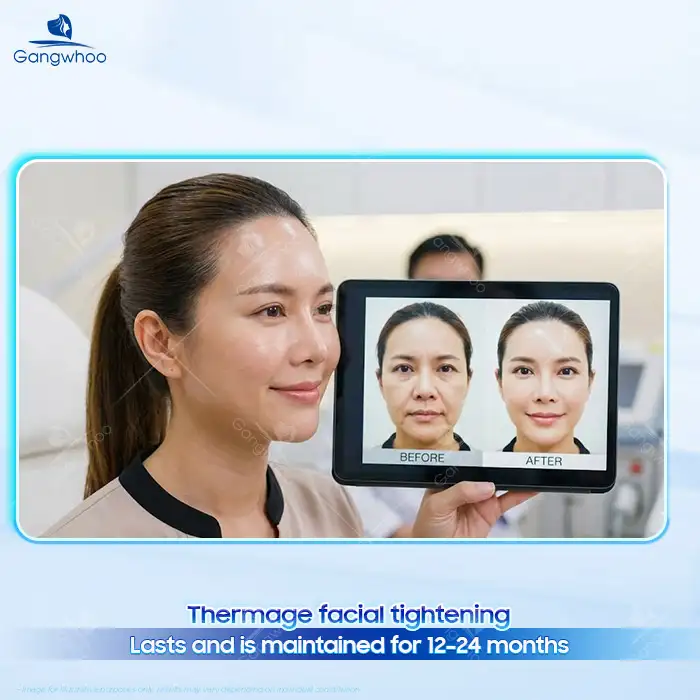 en cang da mat thermage duoc bao lau 3