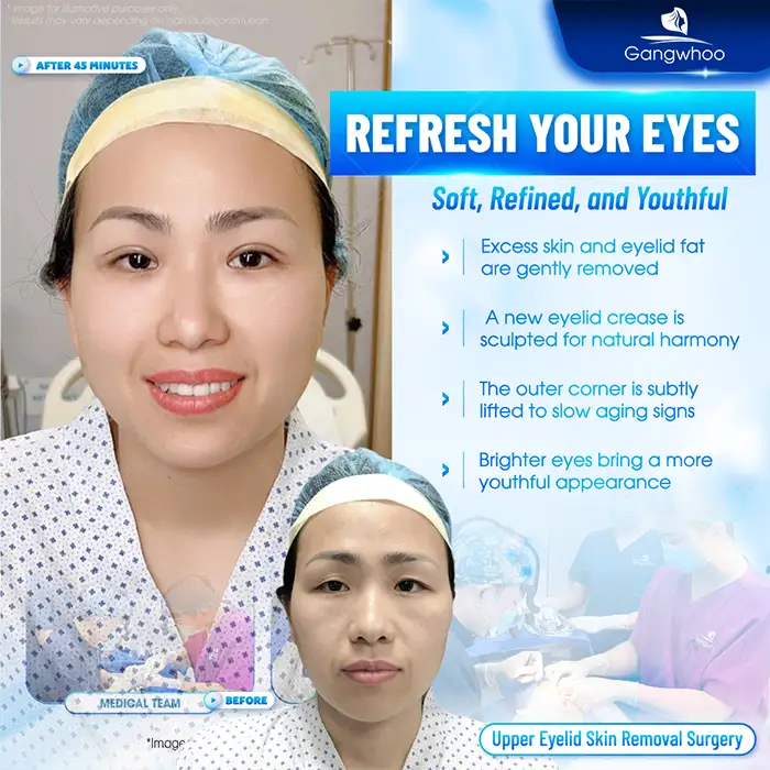 Where is the best place for excess eyelid skin removal? Top 5+ reputable and safe addresses