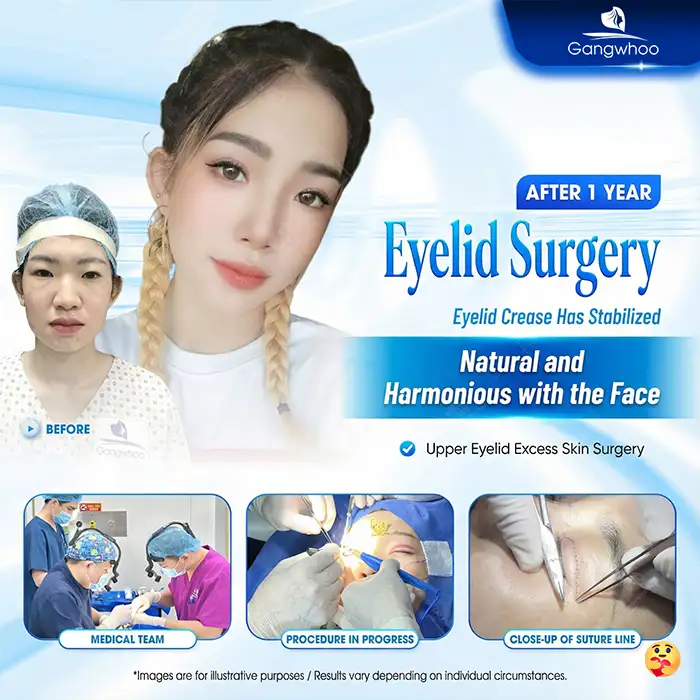 Where is the best place for excess eyelid skin removal? Top 5+ reputable and safe addresses