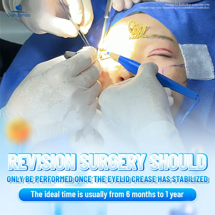 Cắt mí bao lâu thì cắt lại được? Trường hợp nào cần cắt lại