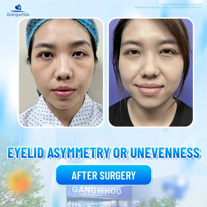 Cắt mí bao lâu thì cắt lại được? Trường hợp nào cần cắt lại