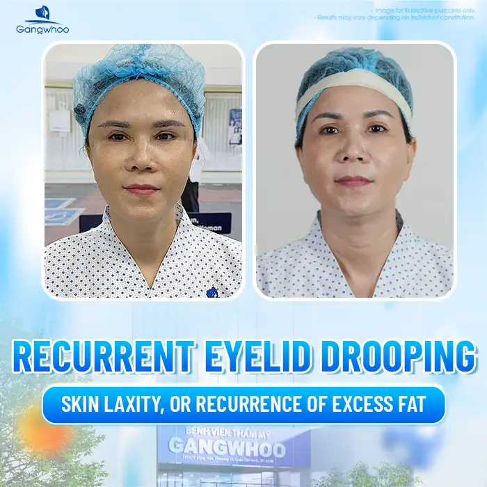 Cắt mí bao lâu thì cắt lại được? Trường hợp nào cần cắt lại