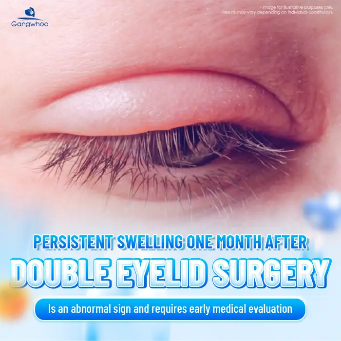 Why is there still significant swelling 1 month after eyelid surgery? What is the cause?