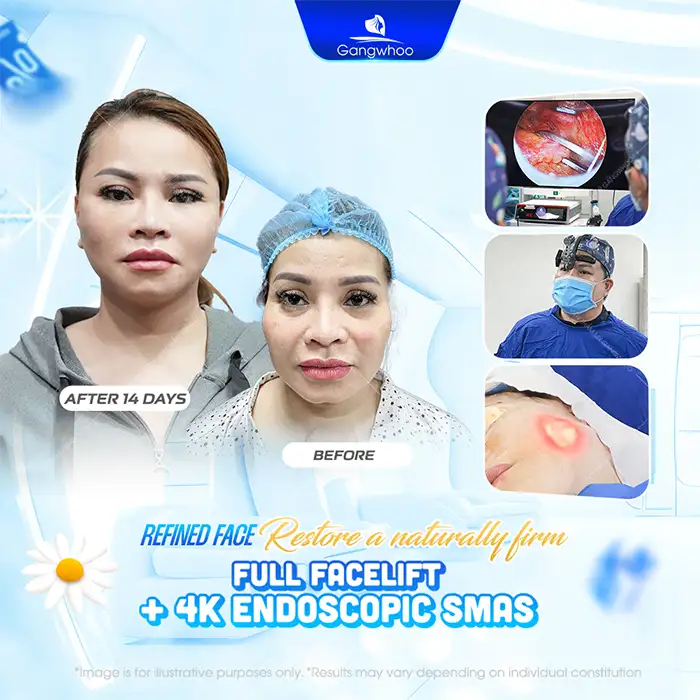 What Is Micro-Thread Skin Brightening and Tightening for the Face? Pros and Cons of the Method