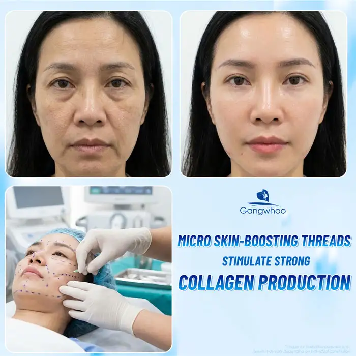 What Is Micro-Thread Skin Brightening and Tightening for the Face? Pros and Cons of the Method