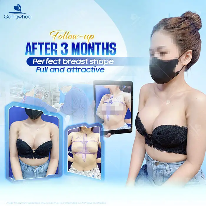 Should You Get Breast Augmentation Before Having Children? Does It Have Any Impact?