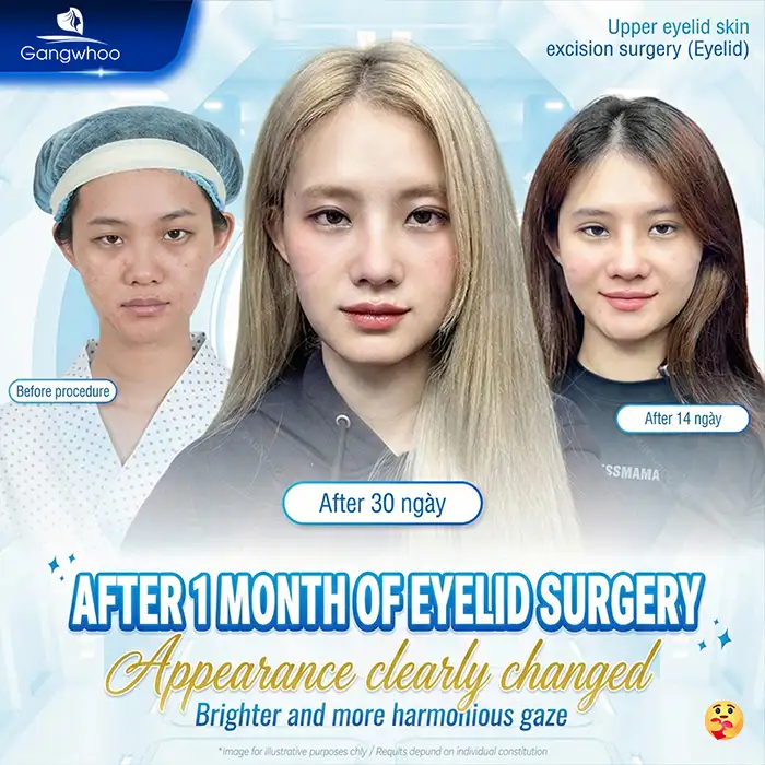 Latest Eyelid Surgery Technologies to Consider in 2026