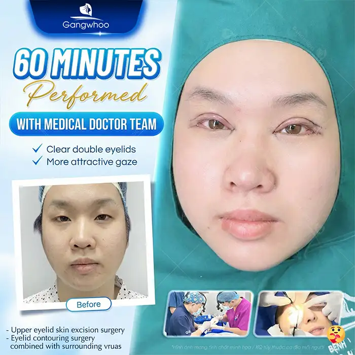 Latest Eyelid Surgery Technologies to Consider in 2026