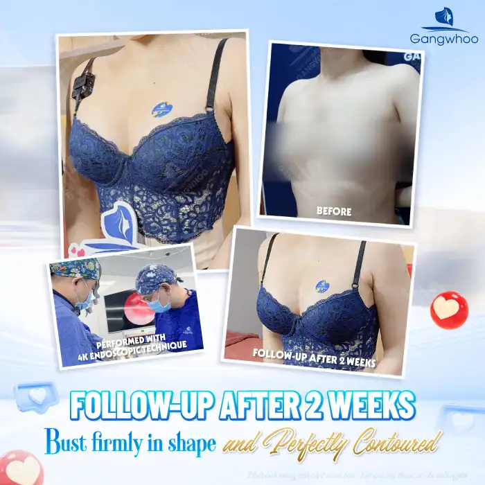 Explore the most modern and latest breast augmentation technologies today