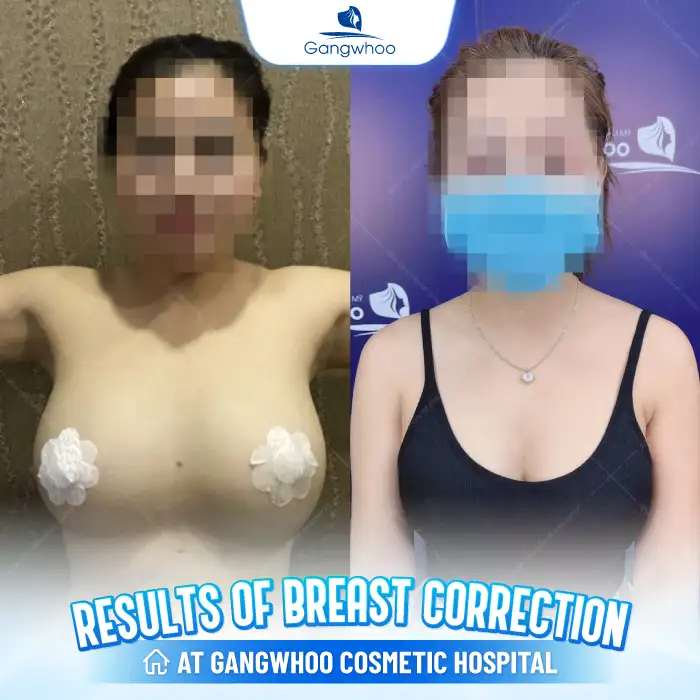 Can failed breast augmentation be corrected? How is it performed?