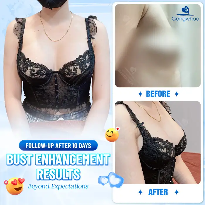 How many years does breast augmentation last? Does it last permanently?