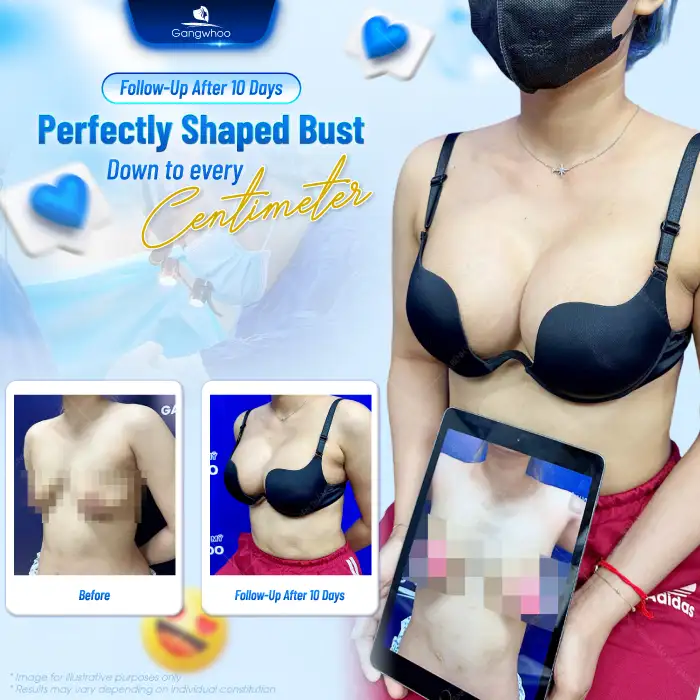 What Is 3D Endoscopic Breast Augmentation? Pros and Cons of 3D Endoscopic Breast Augmentation