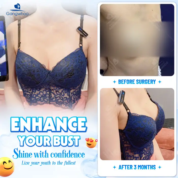 Which Breast Implants Should You Choose? The Best Types of Breast Implants