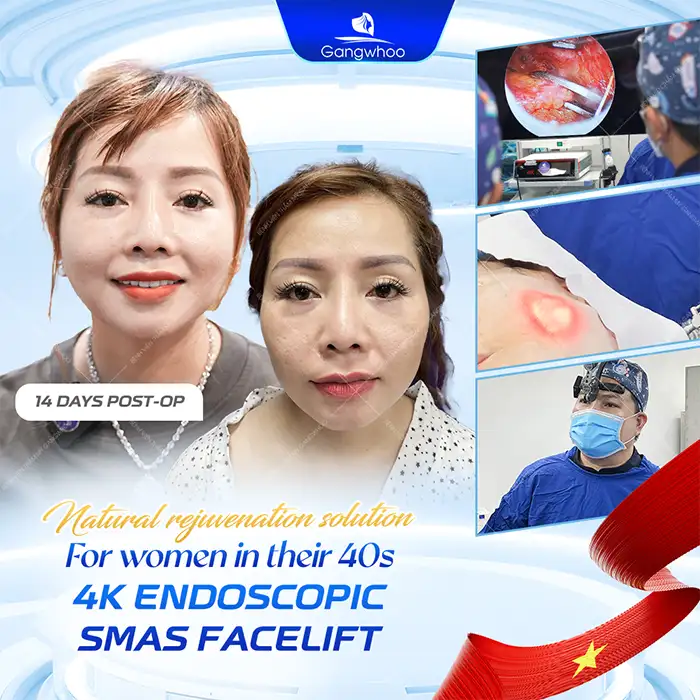 At What Age Should You Get a Facelift? The Ideal Age for a Facelift