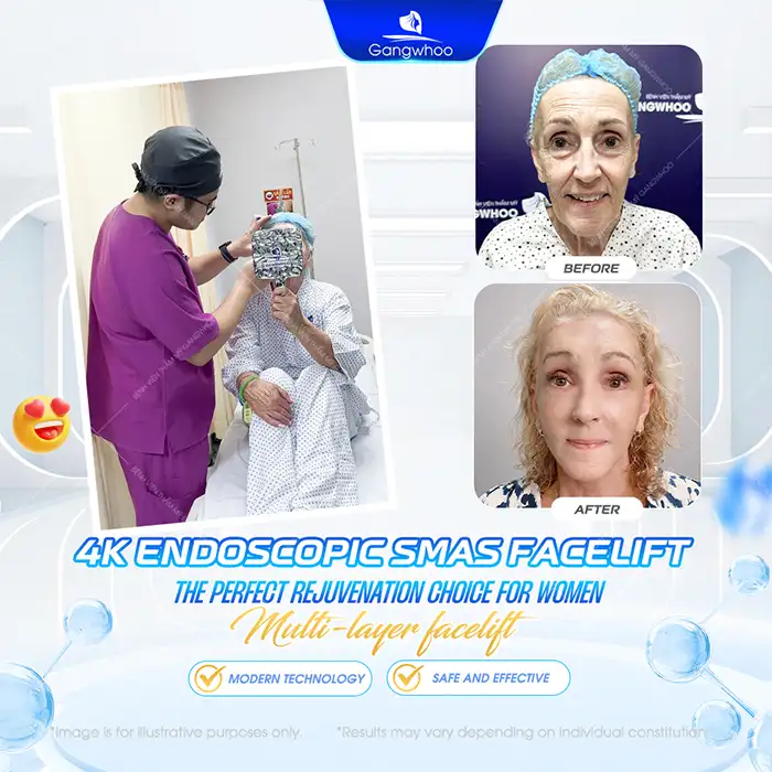 At What Age Should You Get a Facelift? The Ideal Age for a Facelift