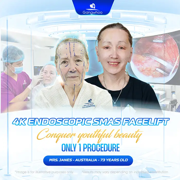 At What Age Should You Get a Facelift? The Ideal Age for a Facelift