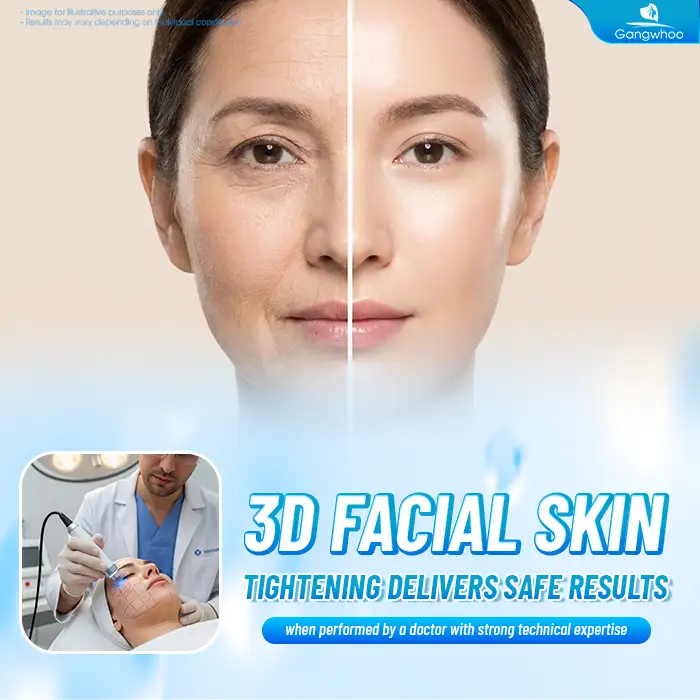 What Is 3D Facelift? Is the 3D Facelift Procedure Safe?