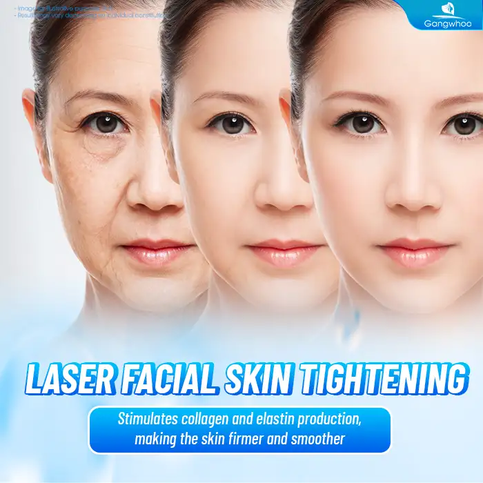 What Is Laser Facelift? Advantages and Disadvantages of Laser Facelift