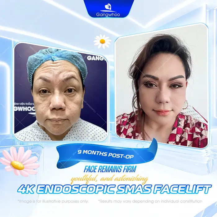 Popular Non-Surgical Facelift Methods Today