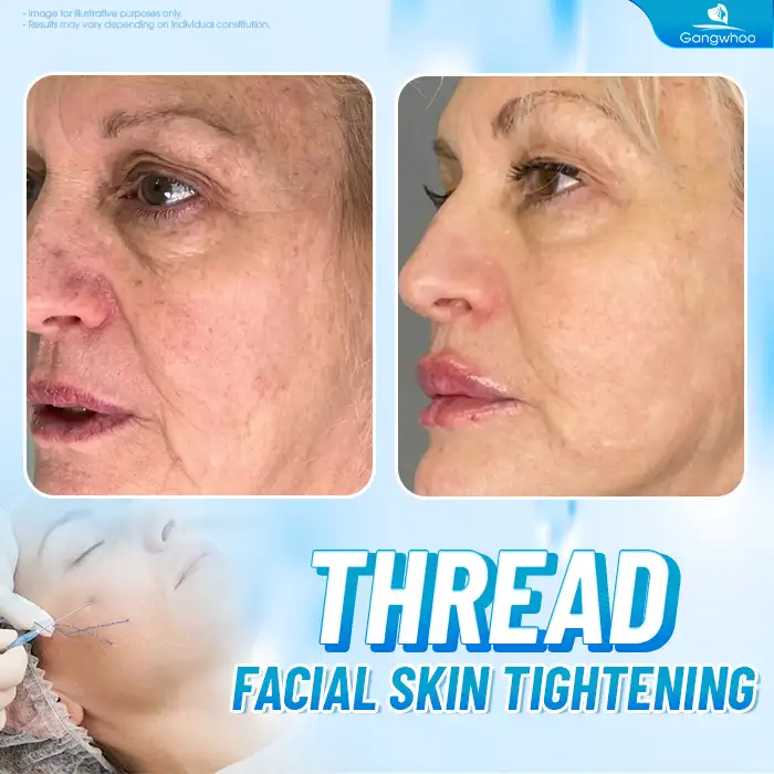 Popular Non-Surgical Facelift Methods Today