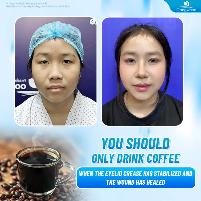 Can You Drink Coffee After Double Eyelid Surgery? How Long Should You Avoid Coffee?