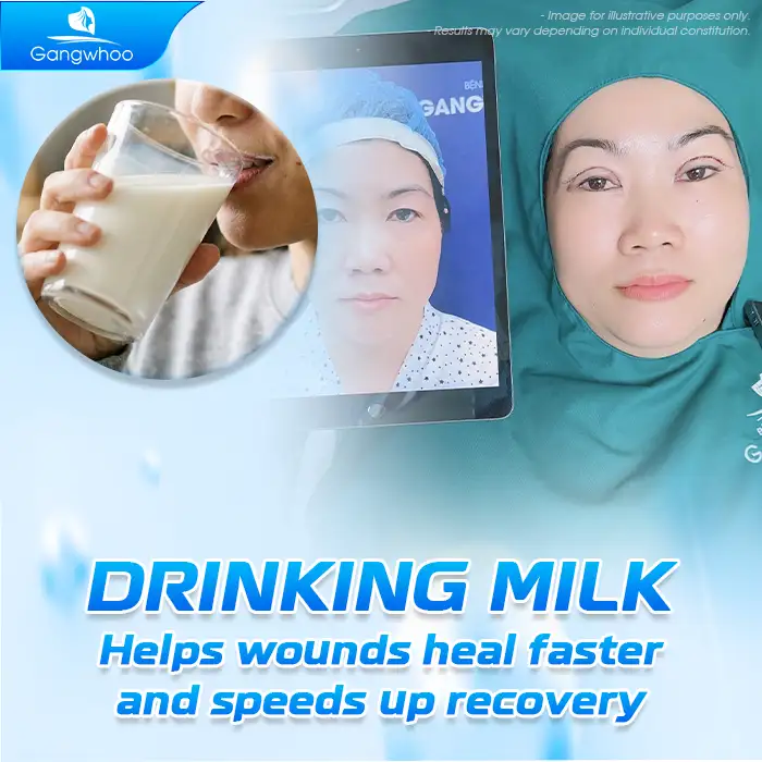 Can You Drink Milk After Eyelid Surgery? Benefits of Drinking Milk After Double Eyelid Surgery