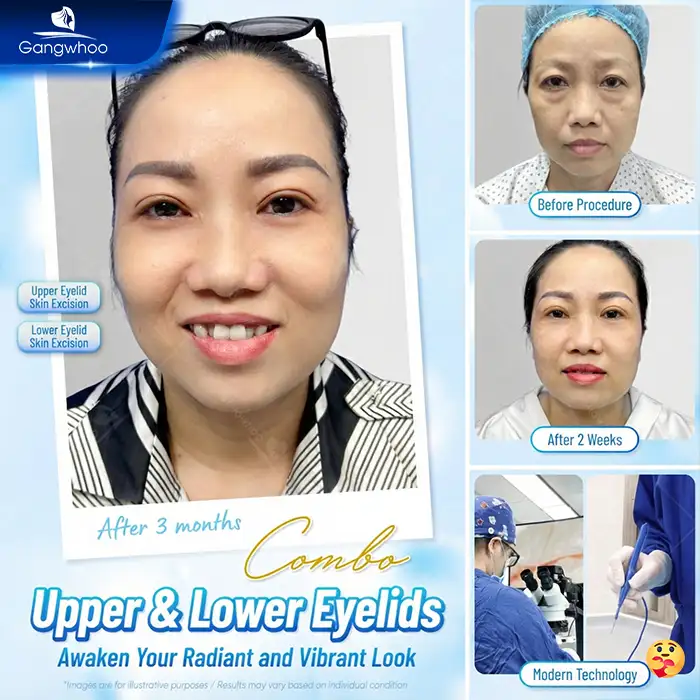 Cắt mí mắt cho người già có an toàn không? Cần lưu ý những gì?