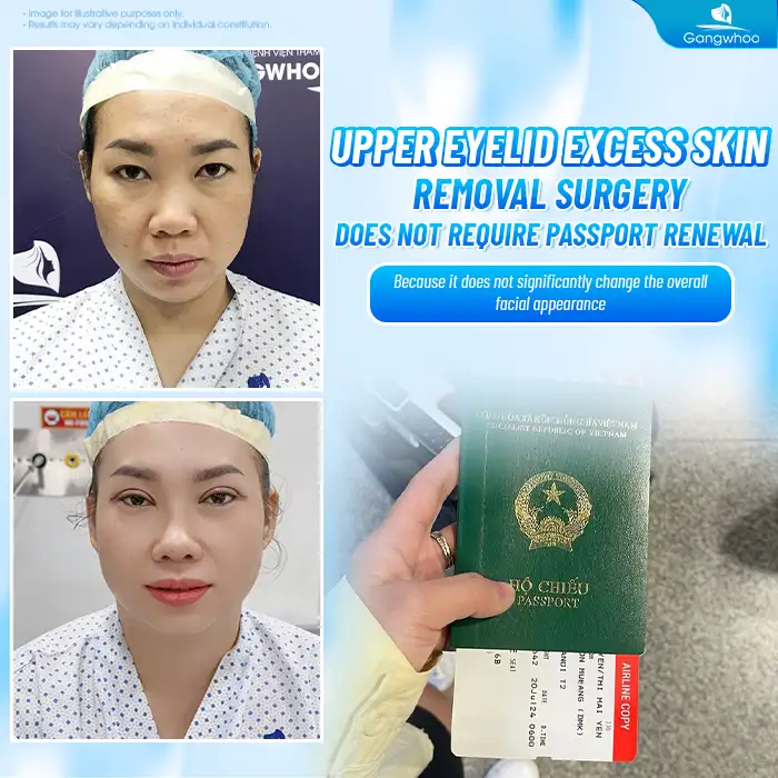 Do You Need to Renew Your Passport After Eyelid Surgery? When Is It Necessary?