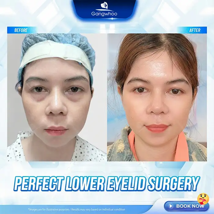 How long does swelling last after Mini Deep eyelid surgery? Recovery time
