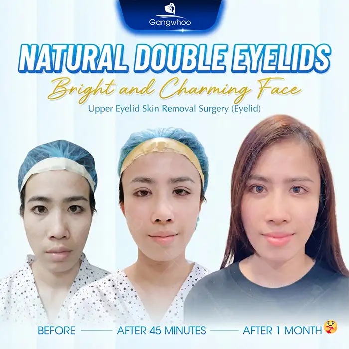 How long does swelling last after Mini Deep eyelid surgery? Recovery time