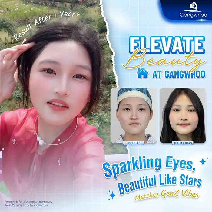 How Long Does Mini Deep Eyelid Surgery Last? Is It Permanent?