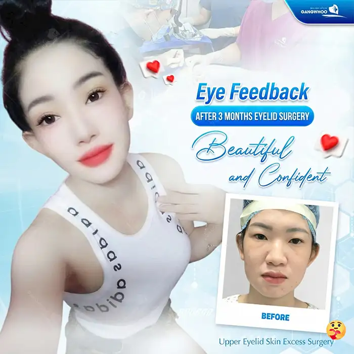 Cutting Mini Deep Eyelids: Where Is Beautiful? Refer to 5 Safe Mini Deep Eyelid Surgery Addresses