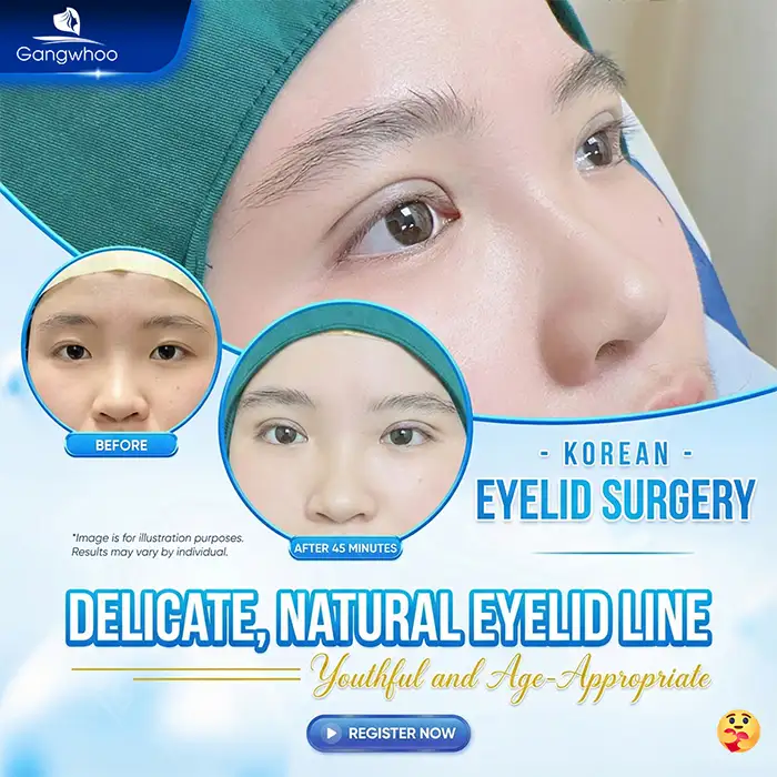 Cutting Mini Deep Eyelids: Where Is Beautiful? Refer to 5 Safe Mini Deep Eyelid Surgery Addresses